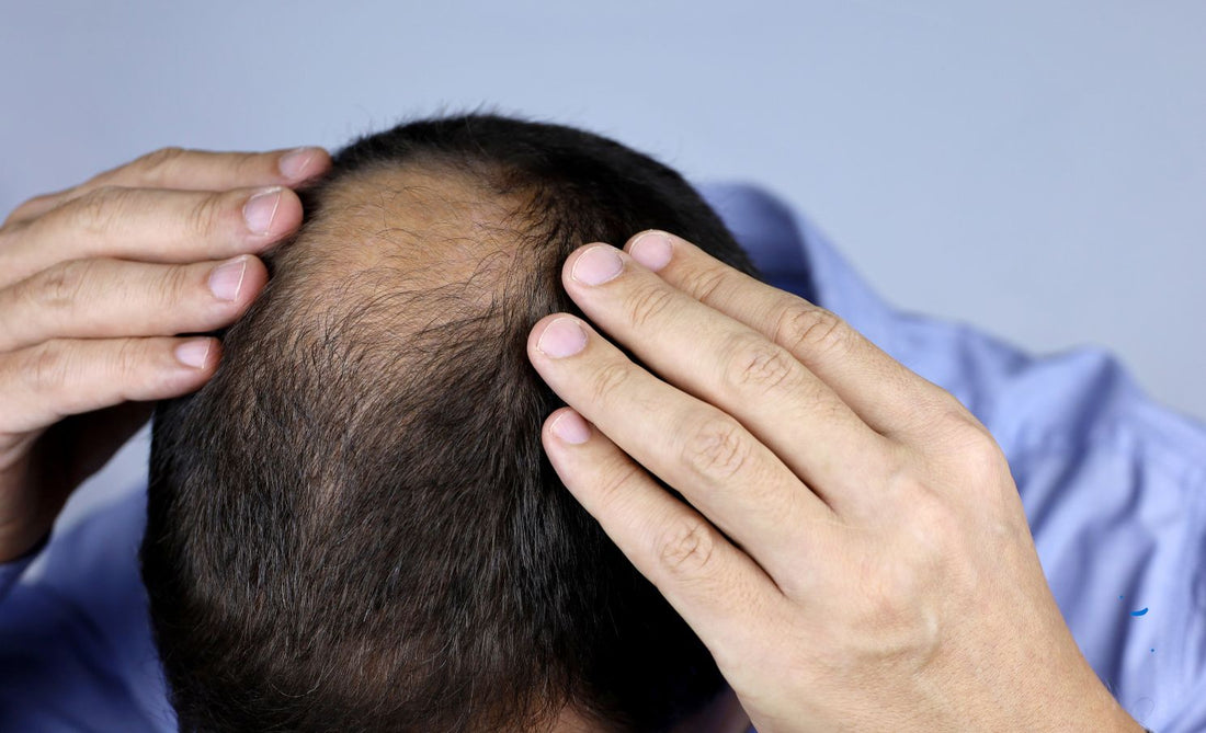 This "Hormone" is the reason why men go bald. Treating hair loss in men