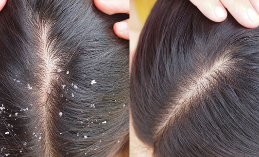 What does Ayurveda say about Dandruff and what is the solution?