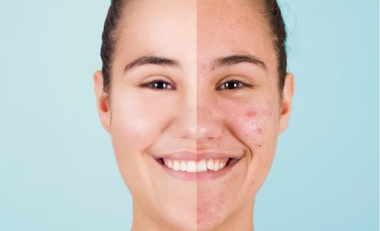 Here's what Ayurveda says about Pimples and Acne