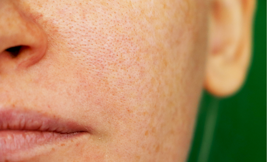 What causes skin pigmentation and how can it be resolved according to ayurveda