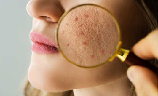 Treating acne based on your ayurvedic skin type