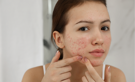 Woman with acne 