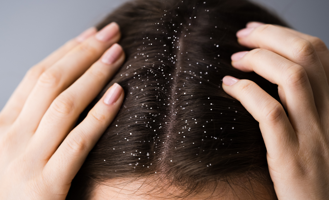 Dandruff in Monsoons? Understand the cause to find the cure.