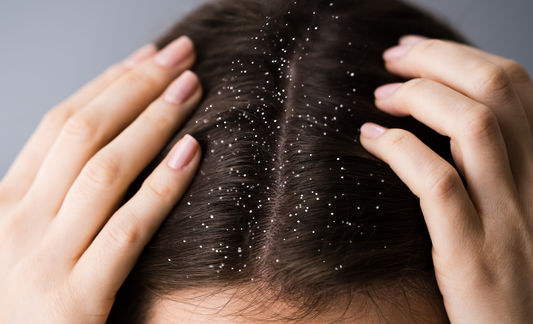 Understanding dandruff and its cause from an Ayurvedic perspective.