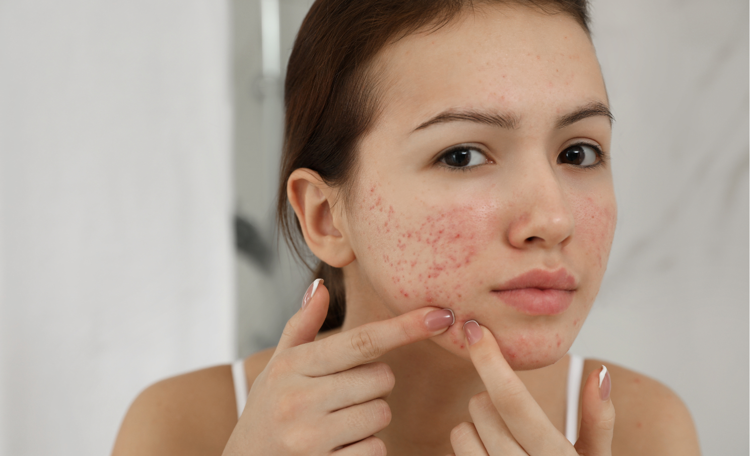 What Causes Pimples And How To Treat Them – Sesa Care